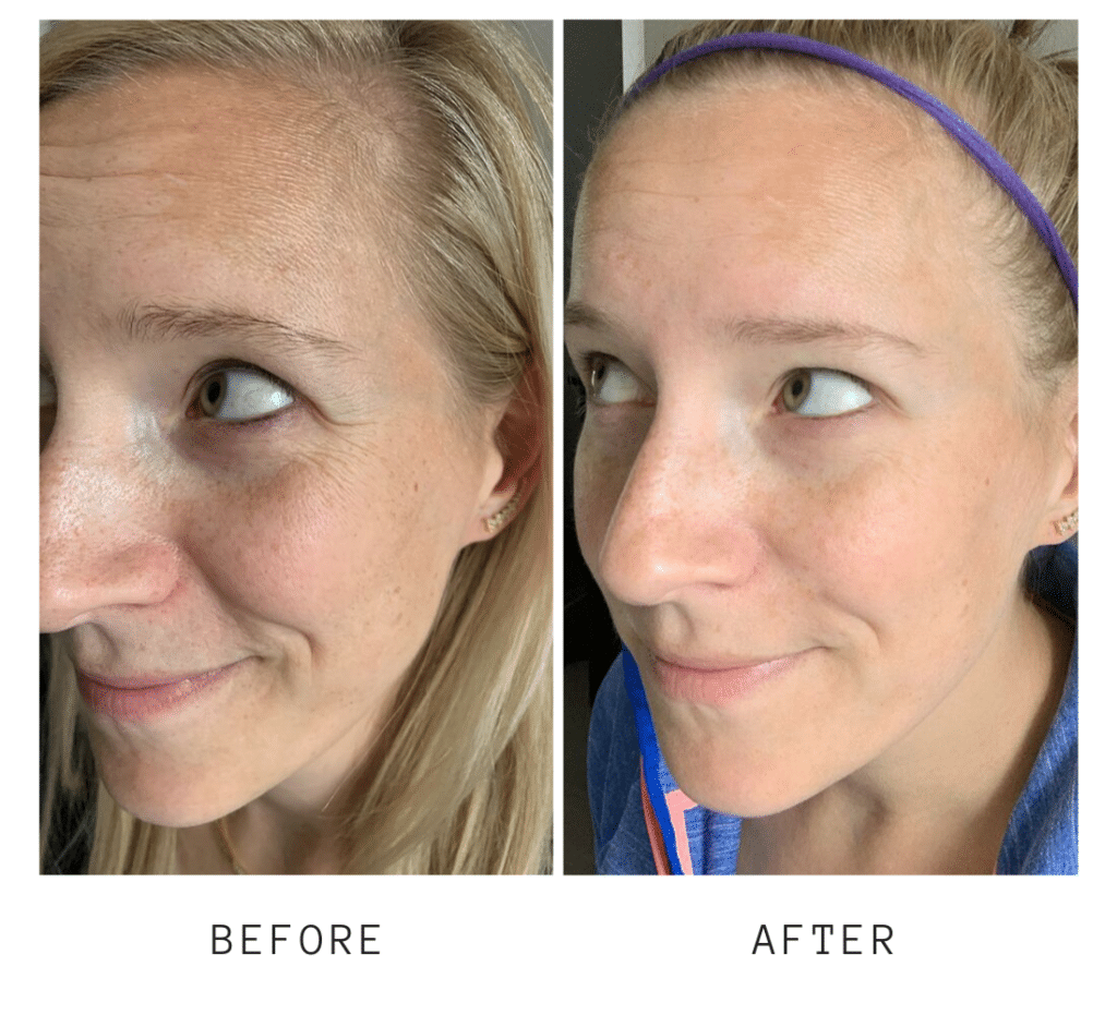 Overnight Resurfacing Peel results Overnight Resurfacing Peel before and after