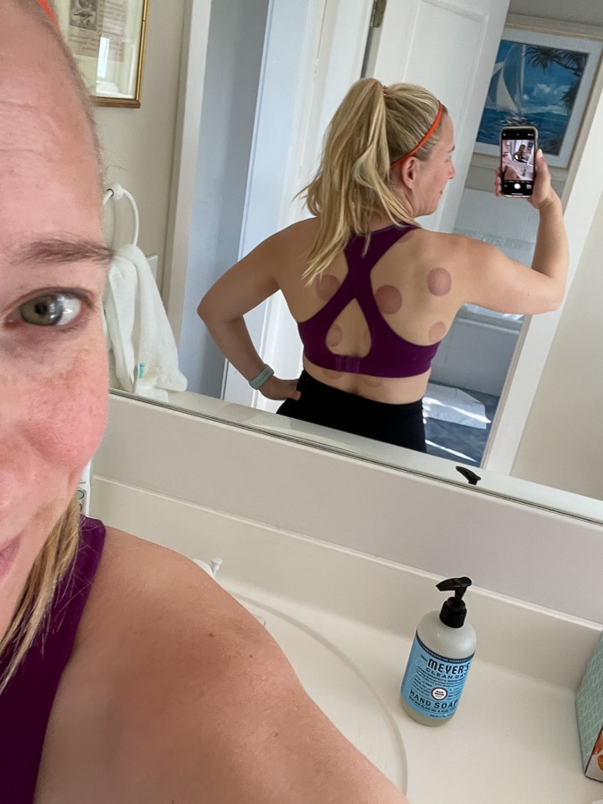 cupping marks cupping marks | Shore Is Beautiful